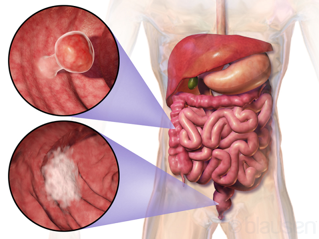 A new automated system to detect colorectal cancer